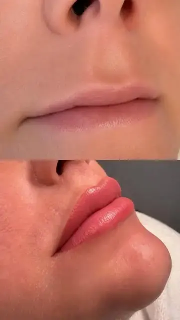 Lippenpigmentierung