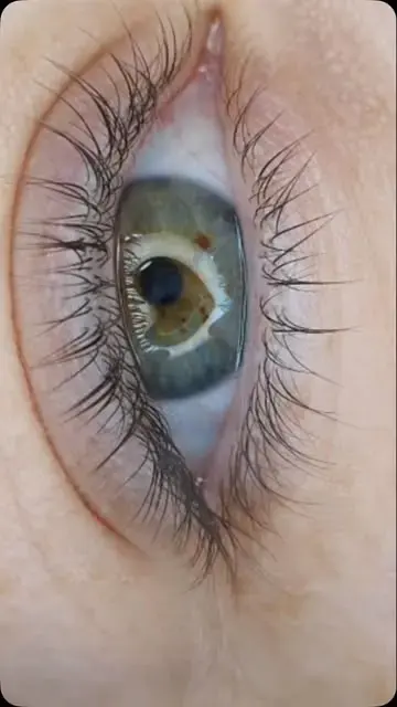 Wimpernkranzverdichtung